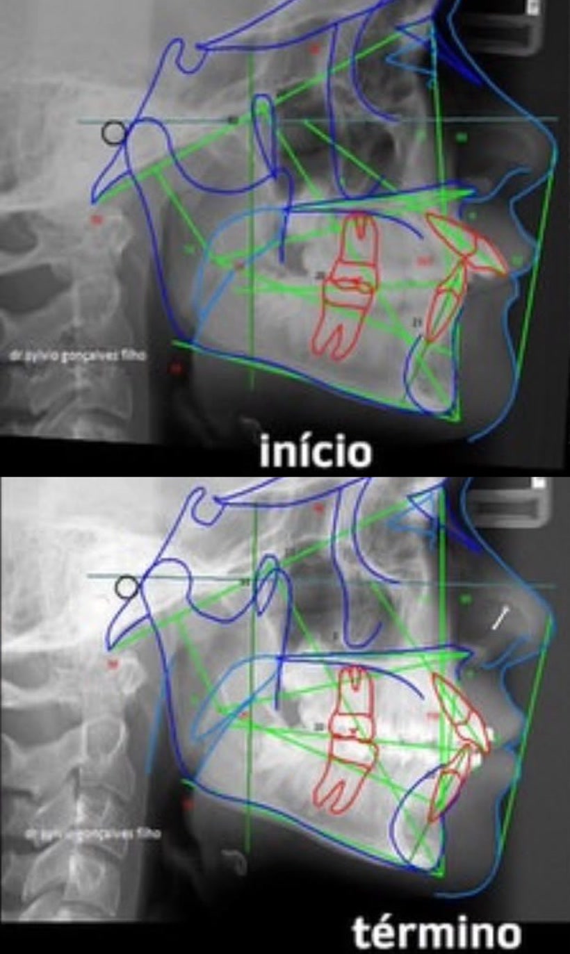 Telerradiografías de inicio y término del tratamiento, con los trazados cefalométricos superpuestos
